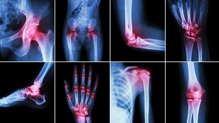 The most frequent are osteoarthritis and rheumatoid arthritis. 2 Rheumatoid arthritis